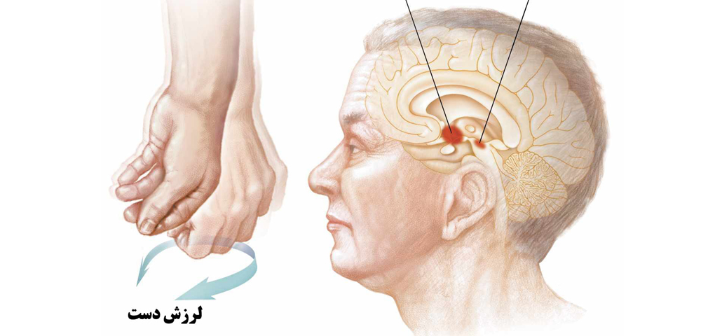 هیدروژل درمان پارکینسون ساخته شد